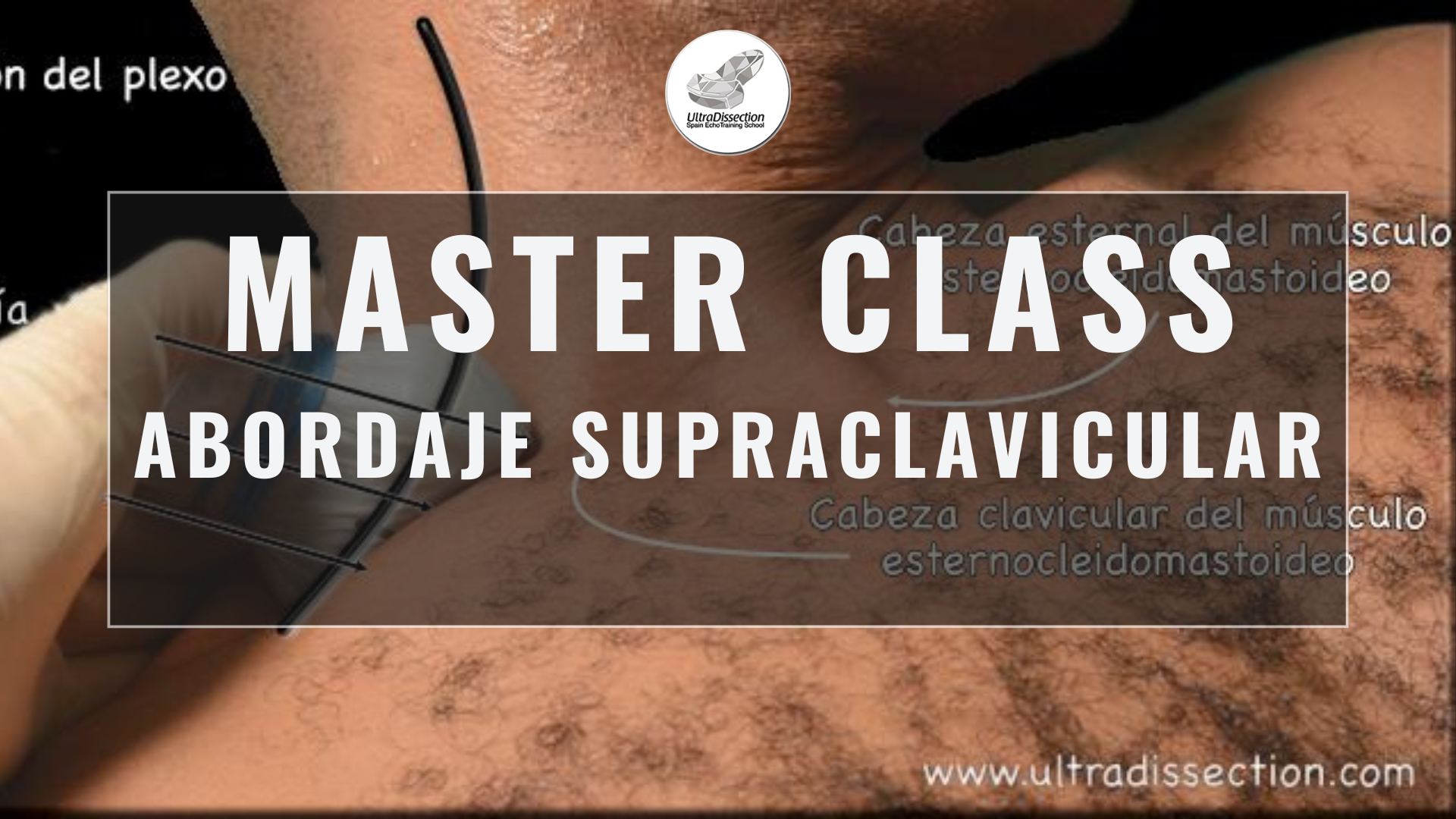 Masterclass 35 | Abordaje supraclavicular – 2